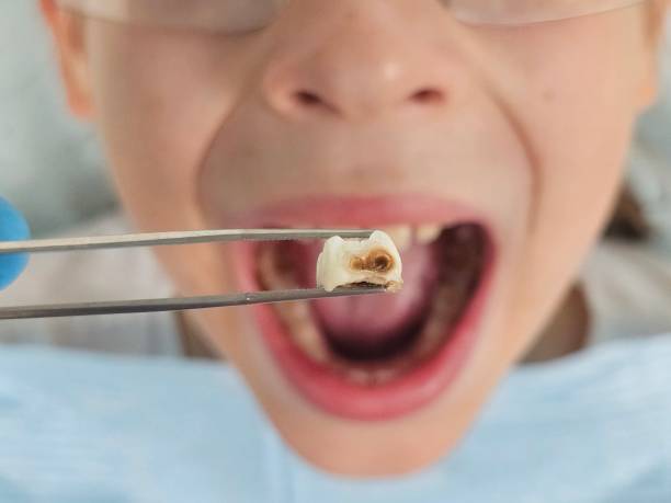 Best Emergency Treatment for Dental Infections or Abscesses in Clinton, AR
